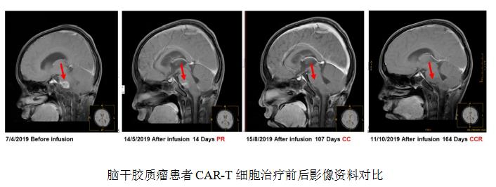 CAR-T治疗脑瘤-从不可能到期望能长期缓解